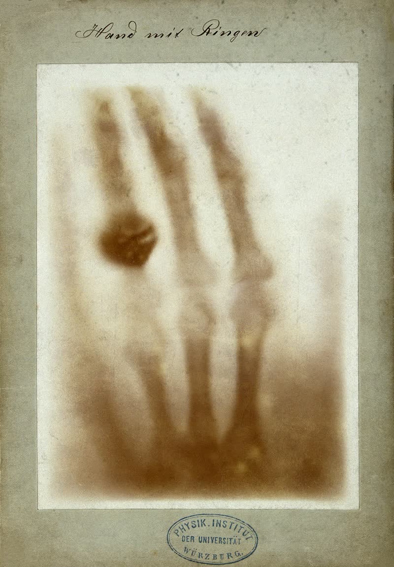 La radiographie de la main d'Anna Bertha Röntgen, en 1895.